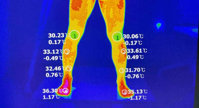 복합부위 통증 증후군 발병 이후 촬영된 열영상 사진. 발병 부위인 오른쪽 발목은 다른 부위보다 높은 온도가 측정된다.
