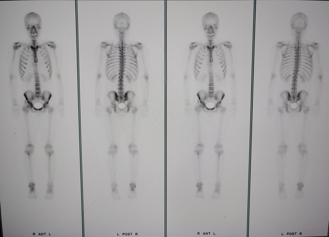군 병원에서 촬영된 X-Ray 사진. 비전문가가 보더라도 발병 부위인 오른쪽 발목에 이상을 볼 수 있다.